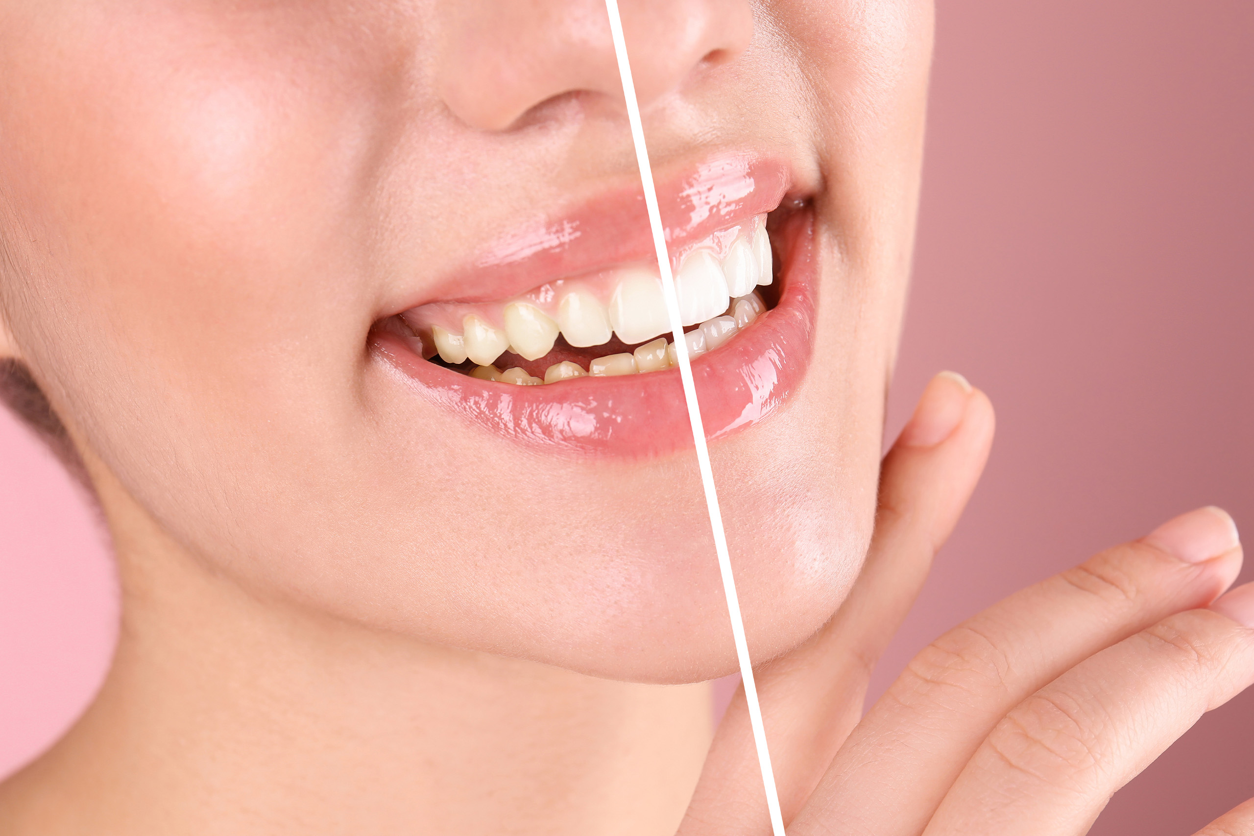 teeth-whitening-bellevue-institute